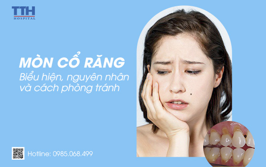 Mòn cổ răng - Biểu hiện, nguyên nhân và cách phòng tránh